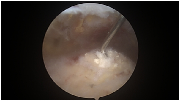 MALAXIAS ARTHRO 4