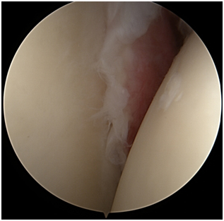 MALAXIAS ARTHRO 5