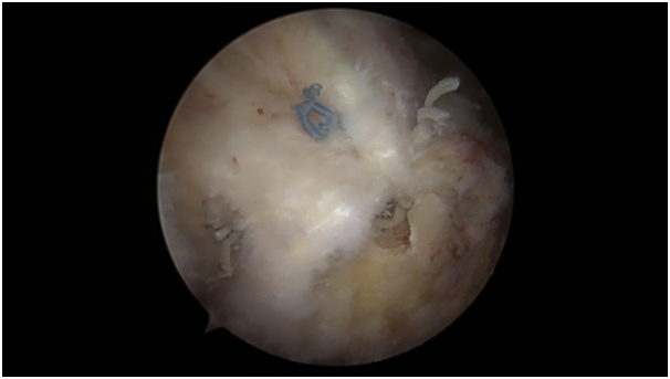 MALAXIAS ARTHRO 7